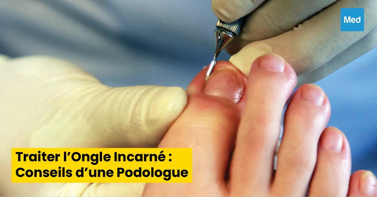 Traiter l'Ongle Incarné : Conseils d'une Podologue